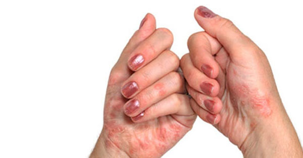 Suurte sormede artriit Suure liigendite ravi poletik